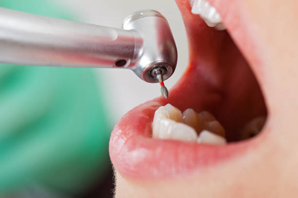 Best Emergency Root Canal Treatment in Venus, TX